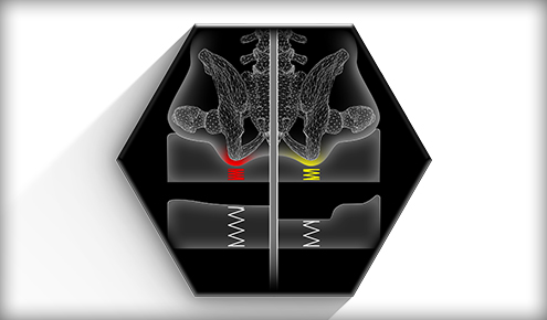 Schemat miednicy i dolnej części kręgosłupa w sześciokątnym polu, pionowo podzielony, z czerwonym i żółtym podświetleniem przy stawach krzyżowo‑biodrowych i ikonami sprężyn.